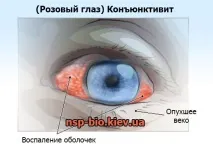 Кон’юнктивіт у дітей – застосування крапель колоїдного срібла НСП для очей дітей