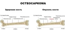 Лікування саркоми у Німеччині саркоми