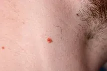 папиломи сапун