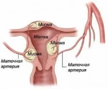 Лікування міоми матки лікарськими препаратами спіраль мирна, гормональна терапія міоми