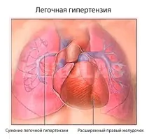 белодробна белодробна