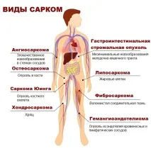 Лікування саркоми у Німеччині тканини