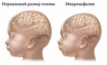 микроцефалия причини