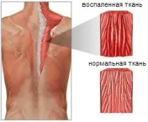 Міозит симптоми, причини, лікування, місця запалення м’язів міозит