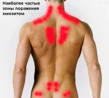 Міозит симптоми, причини, лікування, місця запалення м’язів лікування