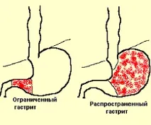 Очищення шлунка при гастриті шлунка