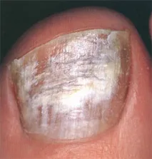 Оніхомікоз грибок нігтів, як виглядає, фото лікування, препарати нігтів