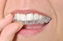 invisalign подравнители