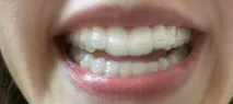 invisalign подравнители