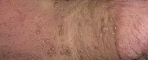 папиломи папиломи