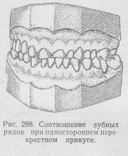 Перехресний прикус, Ортопедична стоматологія прикус