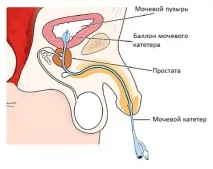 операция хидронефроза
