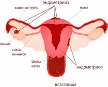 Препарати для лікування ендометріозу препарати