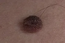 невуси