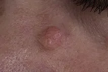 родимка