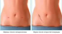 Шрами після лапароскопії причини, особливості та догляд лапароскопії