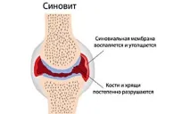 лечение симптоми