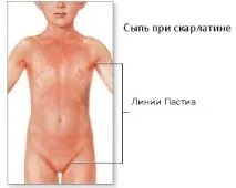 Скарлатина у дітей, Дитина до року дітей