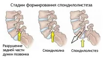 Спондилоліз хребта, в тому числі l5 хребця що це таке, лікування, особливості гострої, спондилоліз