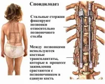 Спондилоліз хребта, в тому числі l5 хребця що це таке, лікування, особливості гострої, спондилоліз
