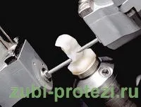 cerec зъбната протеза