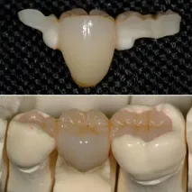 зъбни cerec