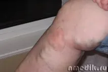 причини симптоми