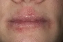 атопичен лечение