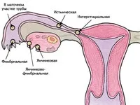 лечение симптоми