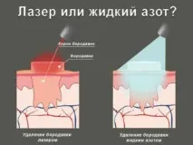 течен азот Премахването брадавици