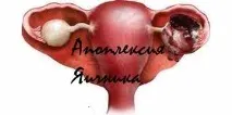 симптоми апоплексії яєчника апоплексії