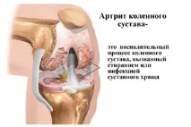 причини коляното