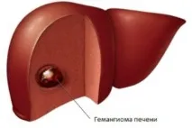 чернодробна хемангиома