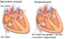 Брадикардія основні симптоми та методи лікування симптоми