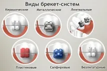брекети цената