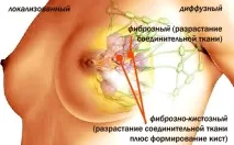 Що таке аденоз молочних залоз таке