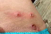 пъпка раната