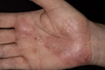лечение лечение