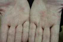 медицински йерсиниоза