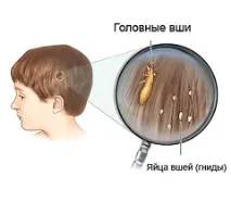 гниди гниди въшки