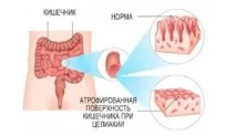 целіакія