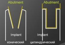 имплантите имплантите