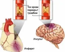 Як швидко відновитися після мікроінсульту в домашніх умовах відновитися