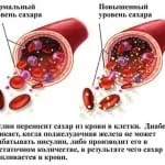 Як зменшити цукор у крові швидко та без ліків при діабеті цукор