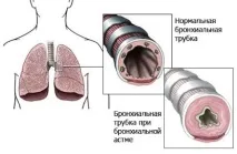 бронхиална астма бронхиална