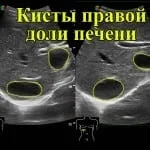киста черния