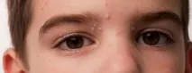 Molluscum contagiosum molluscum