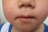 лечение лечение