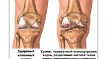 артроза колянната
