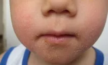 лечение деца